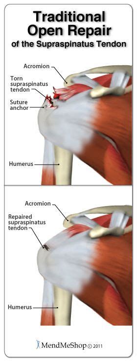 tests for supraspinatus tear|full thickness supraspinatus tear rehab.